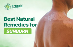 Natural Remedies for Sunburn