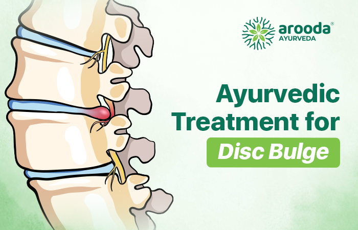 Ayurvedic Treatment for Disc Bulge