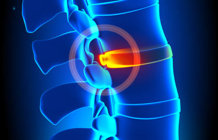 Disc Bulge