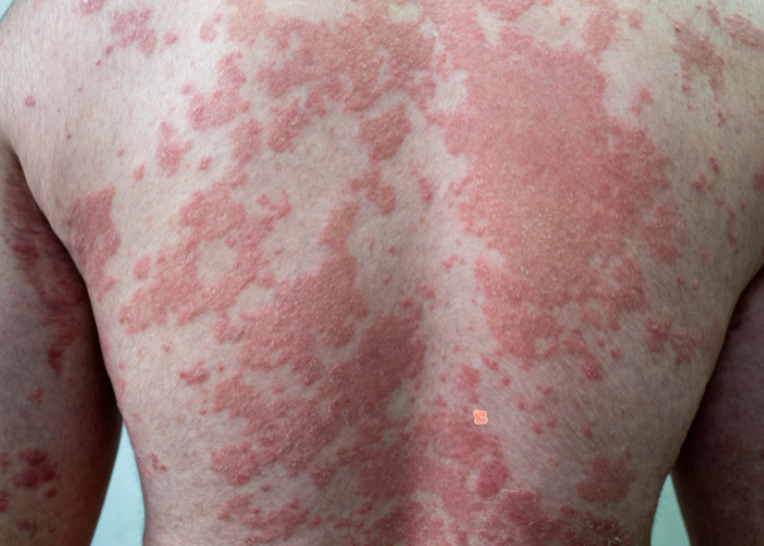 Ayurvedic Treatment for Psoriasis