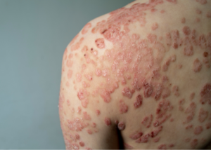 Treatment for Psoriasis